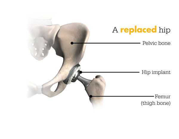 What is a Total Hip Replacement? - Cary Orthopaedics